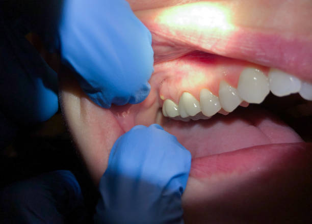 Best Chipped Tooth Repair Near Me  in Charlestown, IN